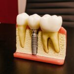 Which Country Abroad Should You Choose To Have Dental Care Implants