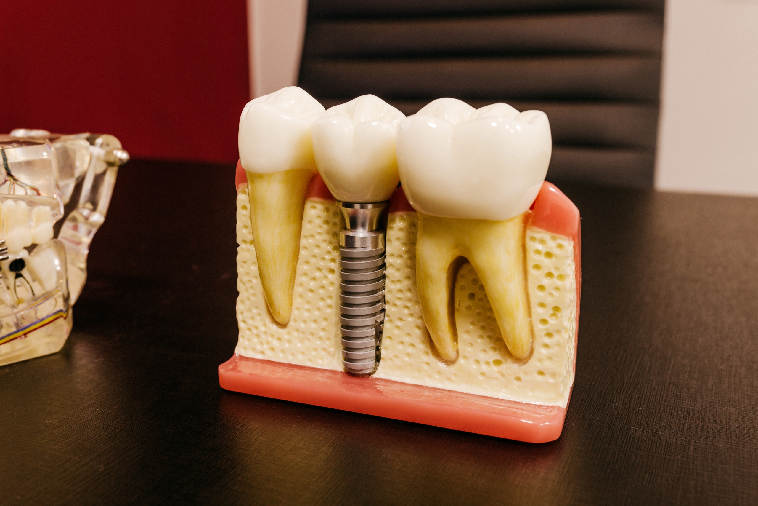 Which Country Abroad Should You Choose To Have Dental Care Implants
