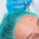 Why Anti Wrinkle Injections Could Benefit You