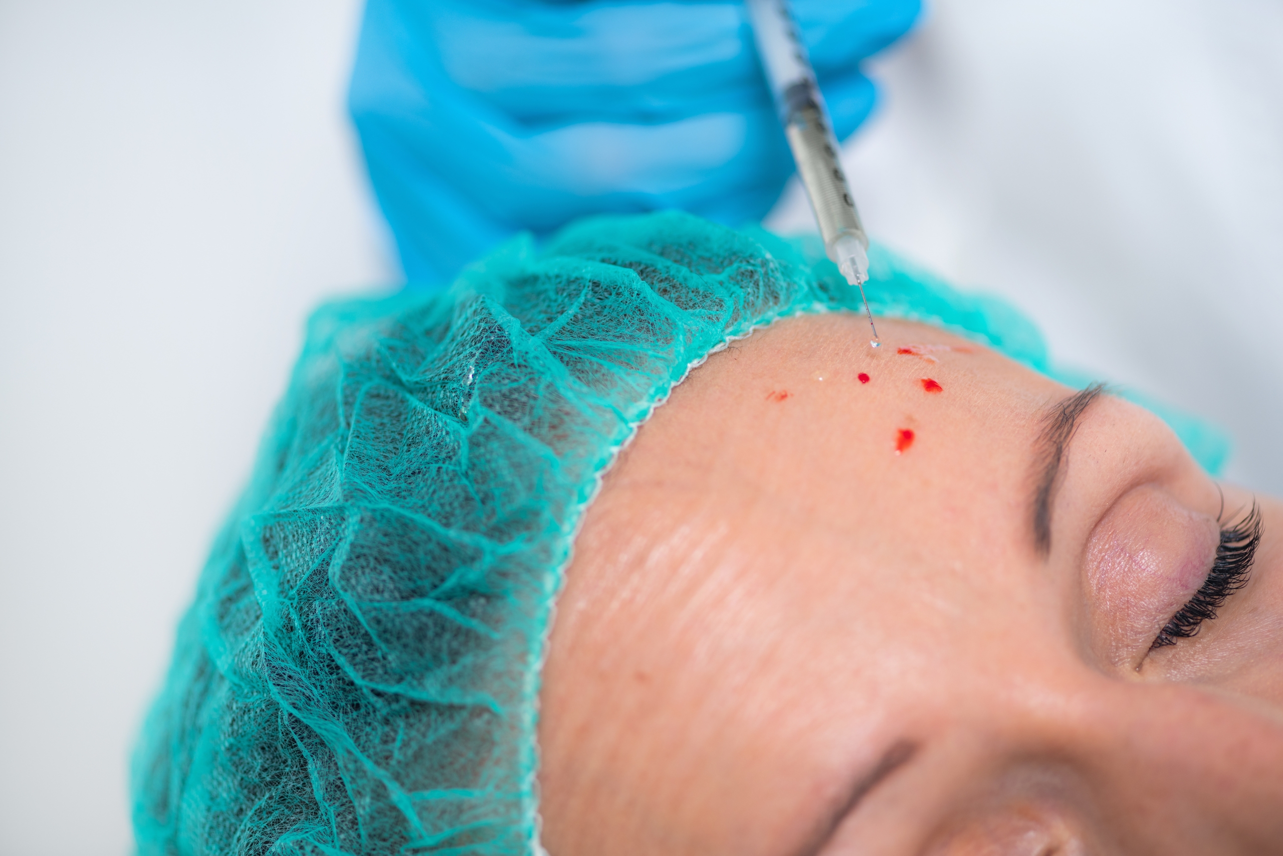 Why Anti Wrinkle Injections Could Benefit You