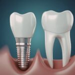Reasons Why People Get Abroad For Dental Implants