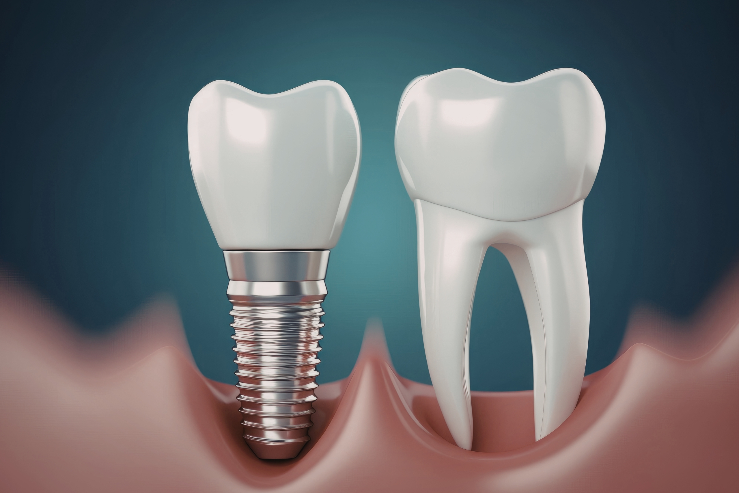 Reasons Why People Get Abroad For Dental Implants