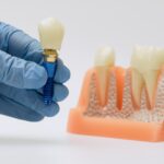 Where You Can Get Dental Implants In Foreign Countries In 2023