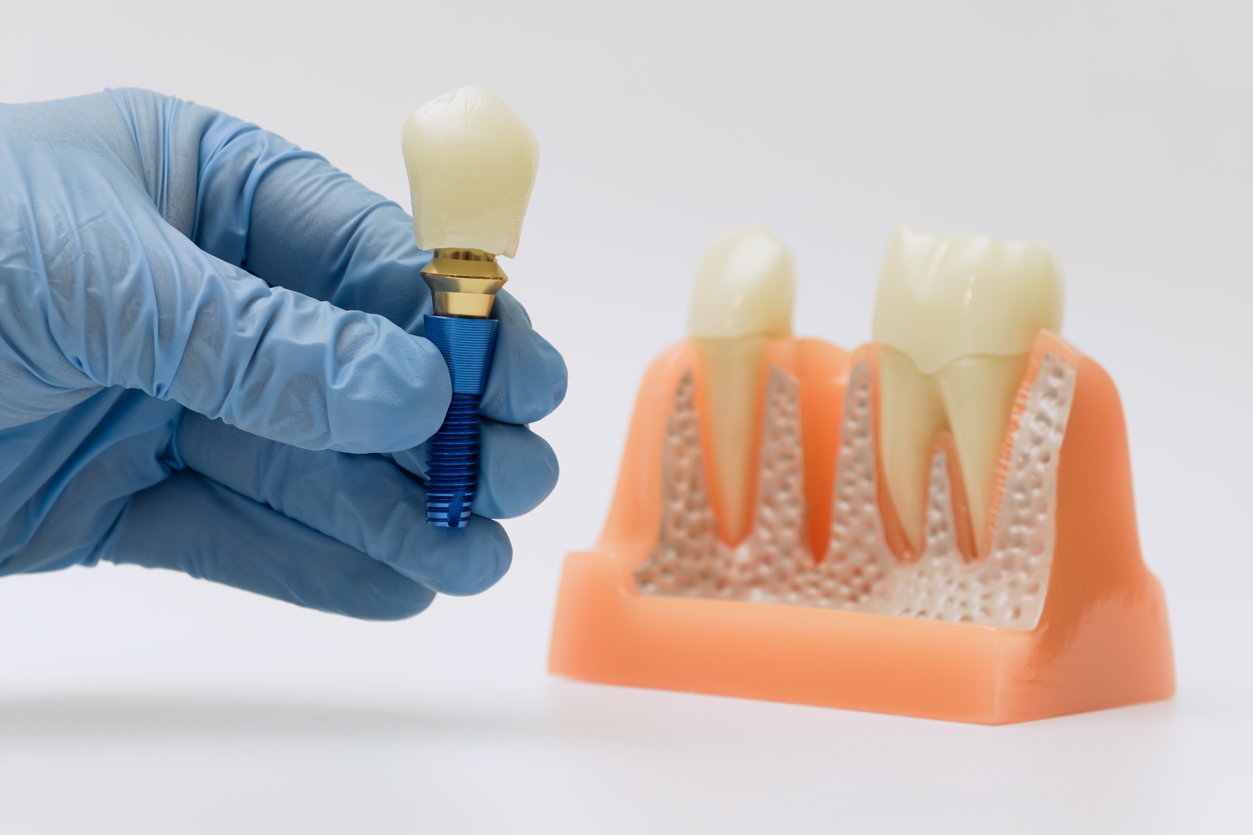 Where You Can Get Dental Implants In Foreign Countries In 2023